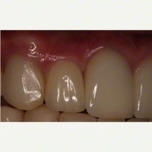 implant after