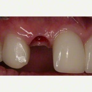 implant before