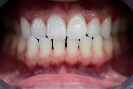 whitening
