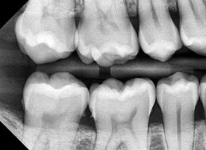 x-ray