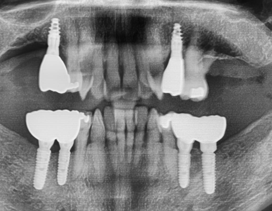 Dental Implants Diamond Dental in Austin, TX